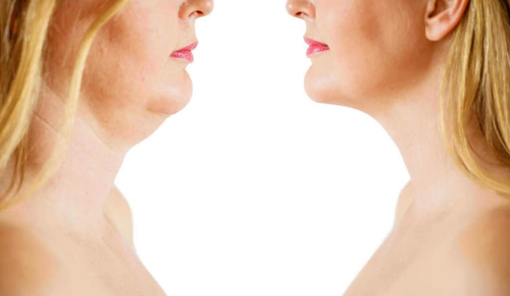 Double Chin treatment Cheshire before and after results