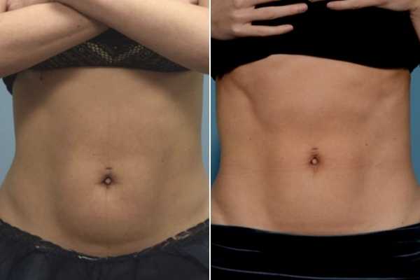 body sculpting FAQs Cheshire