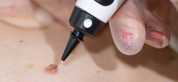 After Skin Tag Removal Cheshire