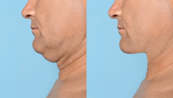 Which Non-Surgical Treatments Work Best for Jowls and Loose Skin Cheshire?