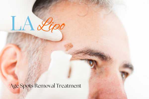What Are the Most Effective Treatments for Age Spots Cheshire?