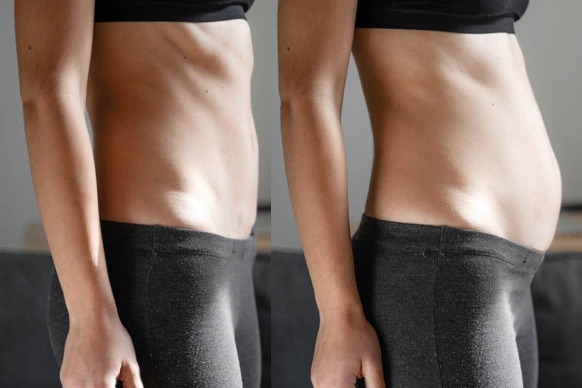 How long does diastasis recti take to improve Cheshire?