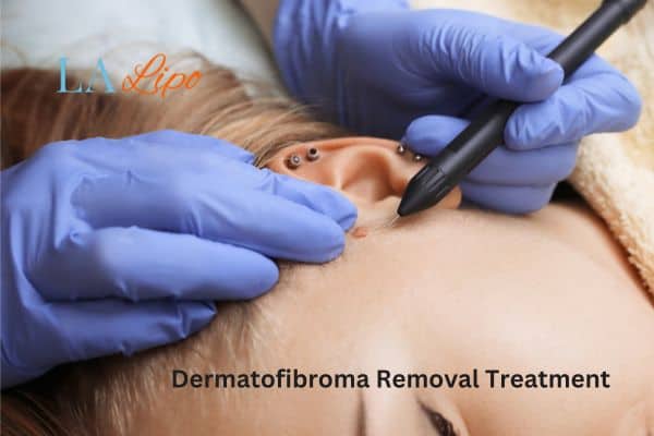 Dermatofibroma Removal Treatment Cheshire