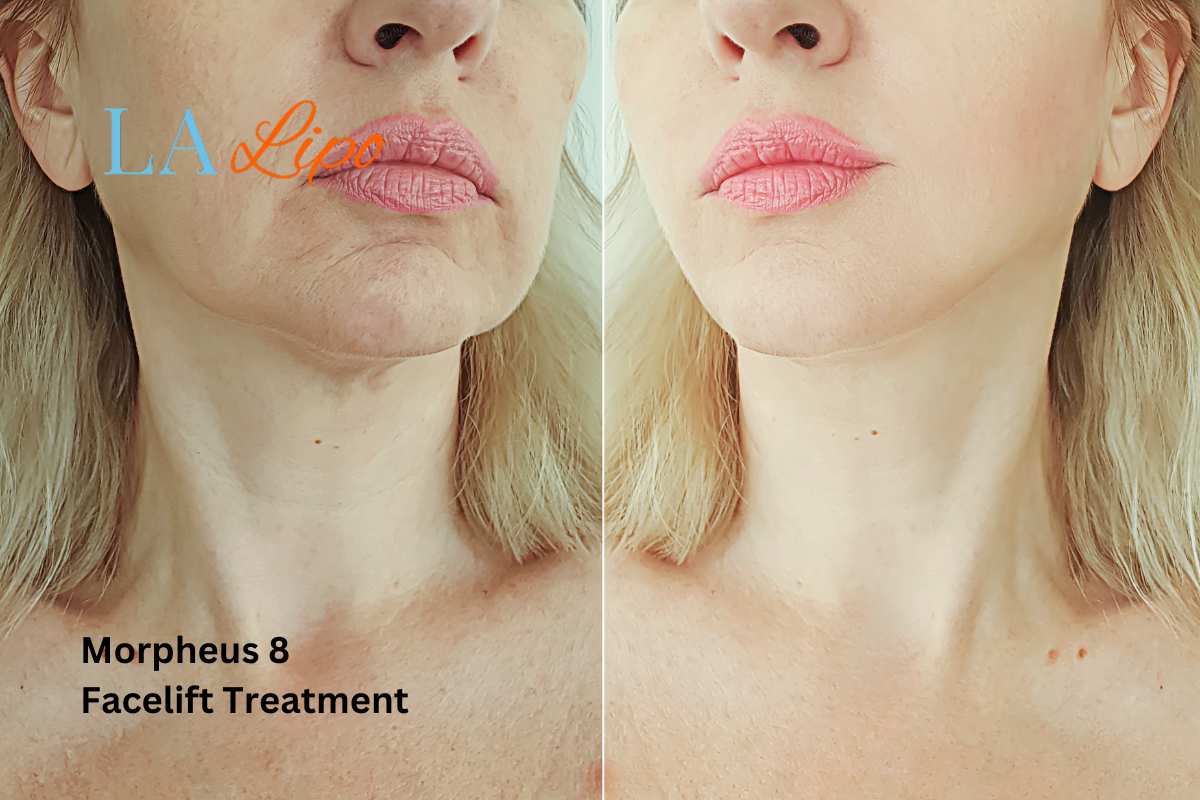 Turn back time with Morpheus8 Treatment Cheshire