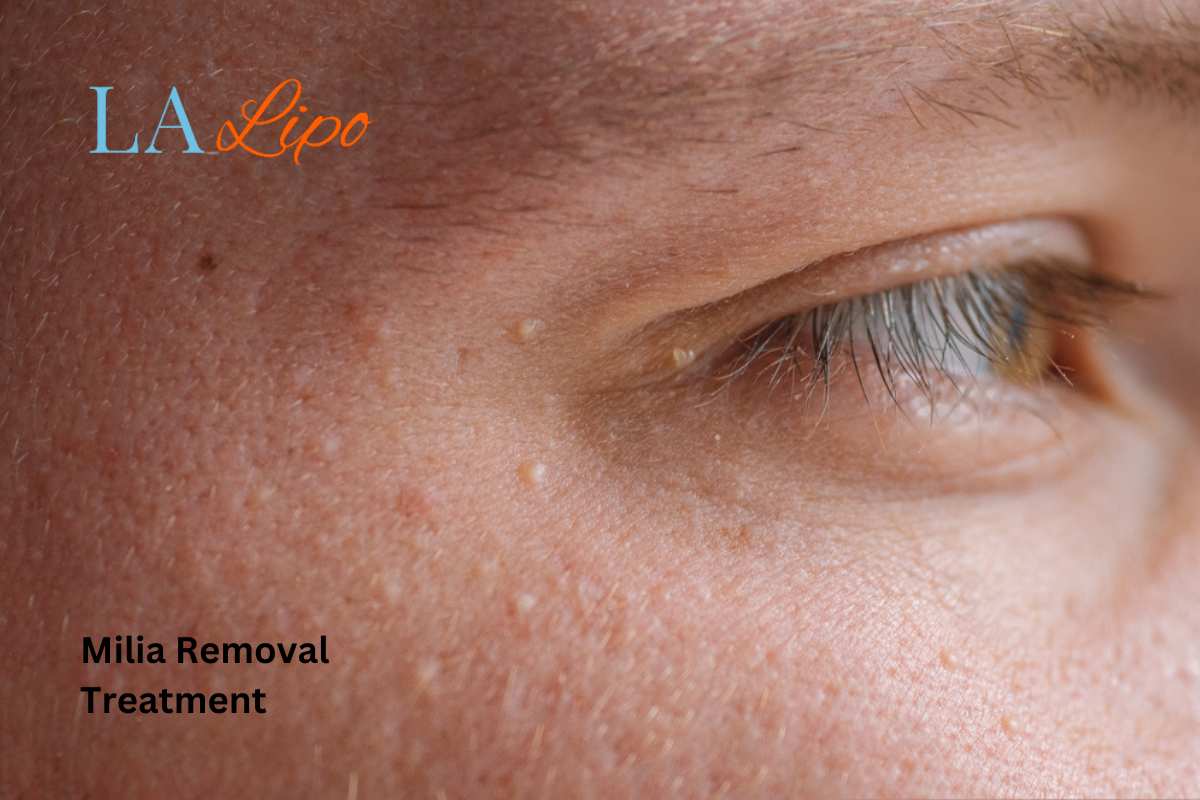 Cryopen Milia Removal: Is It the Easiest and Safest Option Cheshire?