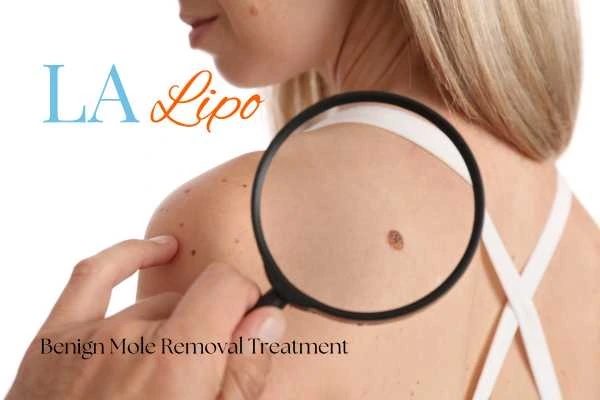Woman having her inspection of blemish before mole removal Cheshire