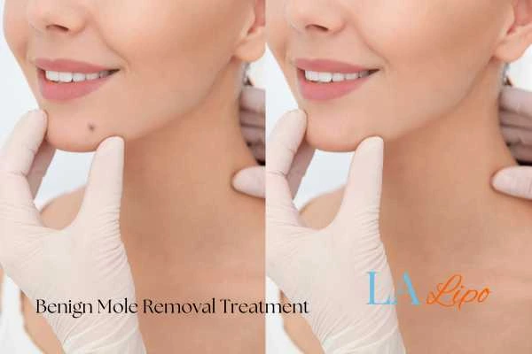 woman's before and after mole removal Cheshire results