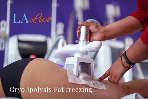 women getting fat freezing Cheshire