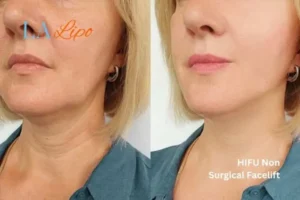 hi-fu for wrinkles Cheshire before and after results