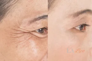 Before and after results of woman - HI-fu wrinkles reduction treatment Cheshire
