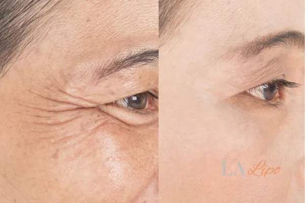 Before and after results of woman - HI-fu wrinkles reduction treatment Cheshire