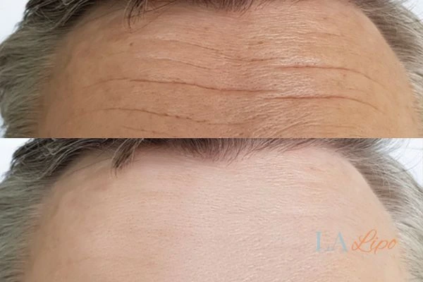 results of HIFU Cheshire on mans forehead to help reduce lines and wrinkles