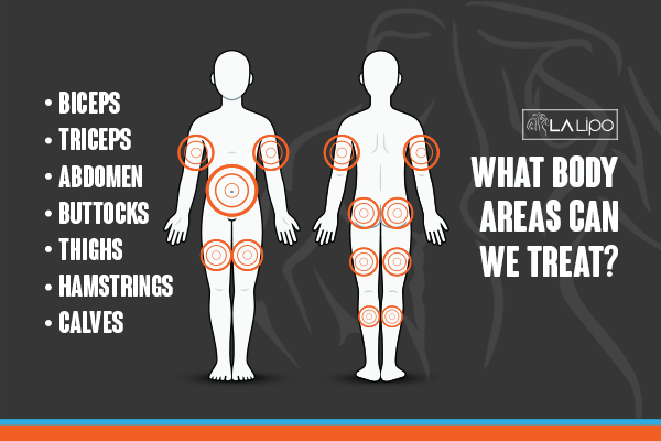 Graphic to show areas you can have LA-EMS Body Sculpting Cheshire treatment.
