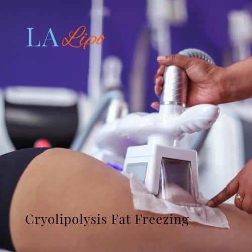 fat freezing - Cryolipolysis Cheshire