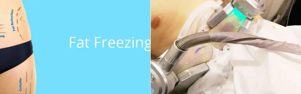 multi areas of a persons body having coolsculpting Cheshire treatment
