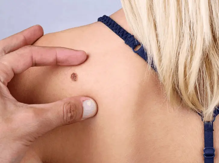 woman having mole removal Cheshire consultation before treatment.