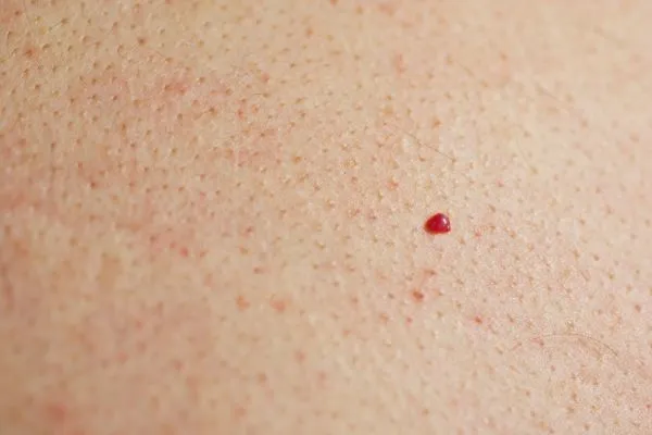 close up of a cherry angioma Cheshire
