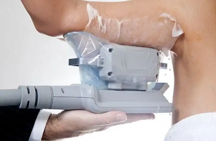 Picture of fat freezing Cheshire on the upper arms.