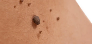 image of a skin tag Cheshire
