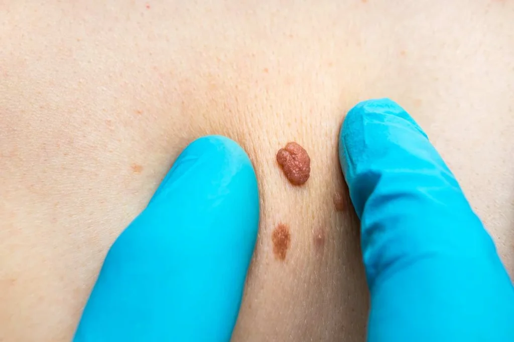 Consultant examining a skin tag Cheshire