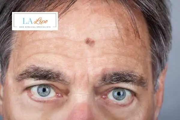 Solar Lentigo Removal Cheshire image of man with mark on his forehead