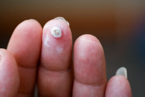 wart on person finger - cryotherapy to treat from LA LIPO Cheshire