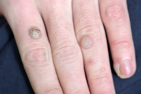 photo of warts on person hand - see wart removal Cheshire from LA LIPO