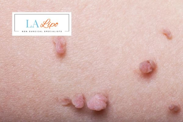 Does cryopen skin tag removal Cheshire hurt? Find out now call our team today!