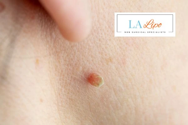 Book skin tag removal Cheshire today speak to our team now!