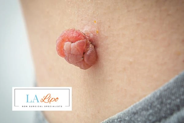 Interested in skin tag removal Cheshire? Concerned about the pain? Find out more today!