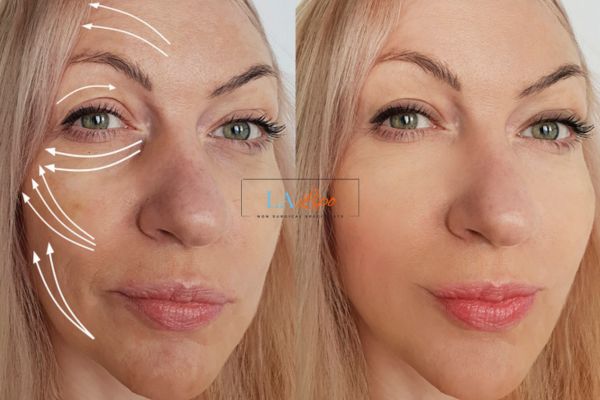 Morpheus 8 results Cheshire face lift.