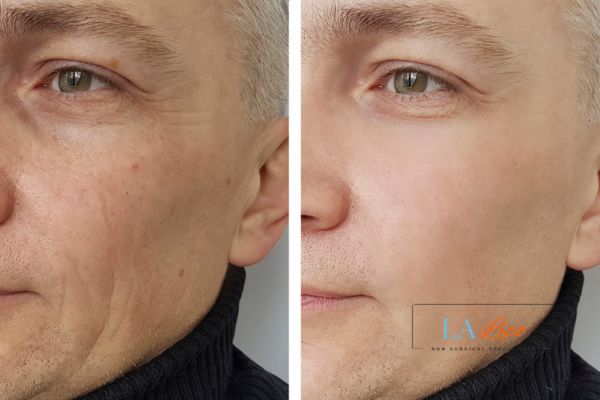 See the amazing results of Morpheus8 Treatment Cheshire!