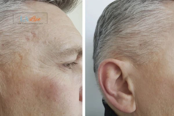 Mens Before & After Morpheus 8 Results Cheshire