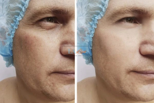 Before and after Morpheus 8 Results Cheshire
