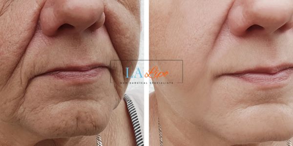 Older lady deeper wrinkle reduction - LA LIPO Morpheus 8 Results Cheshire