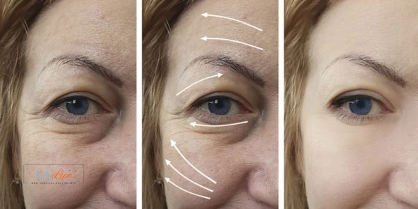 Amazing eye lift Morpheus 8 results Cheshire