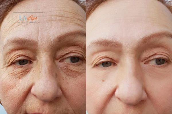 The powerful benefits of Morpheus8 Treatment Cheshire - Call Our team today!