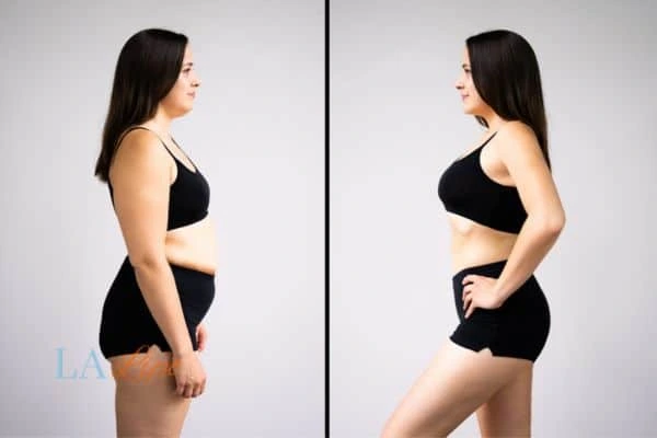 Picture of womans before and after using LA-EMS body sculpting to improve her core strength Cheshire