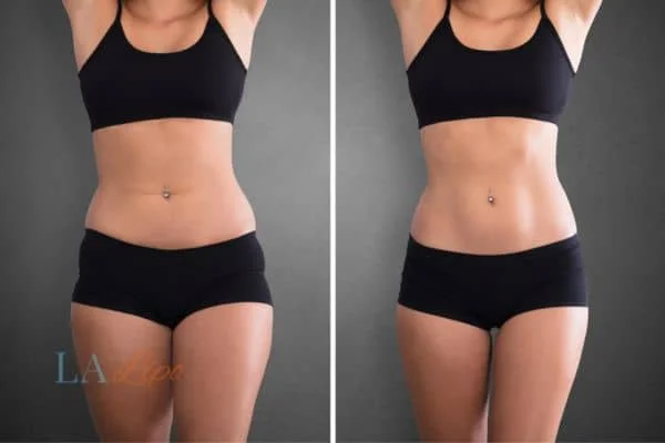 before and after results of non-surgical treatment to help a woman's body image and mental health Cheshire