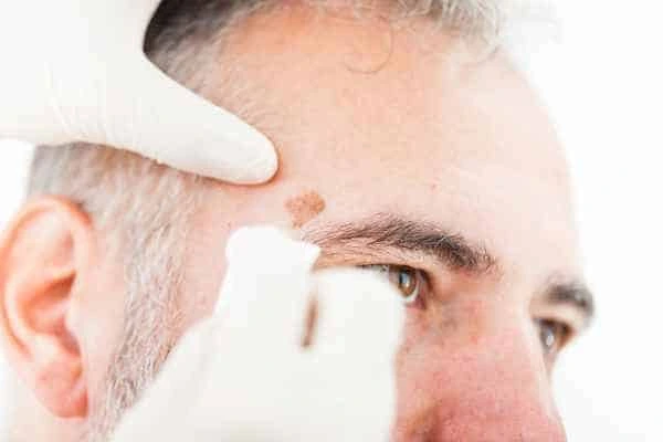 Age spots and elderly people Cheshire what is the link?