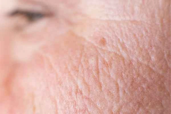 close up picture of a woman's face showing an age spot Cheshire