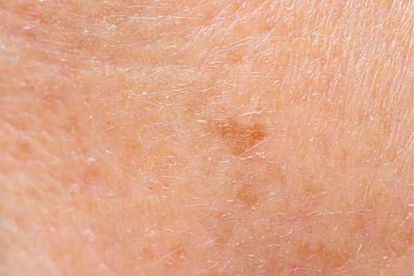 close up picture of age spots Cheshire