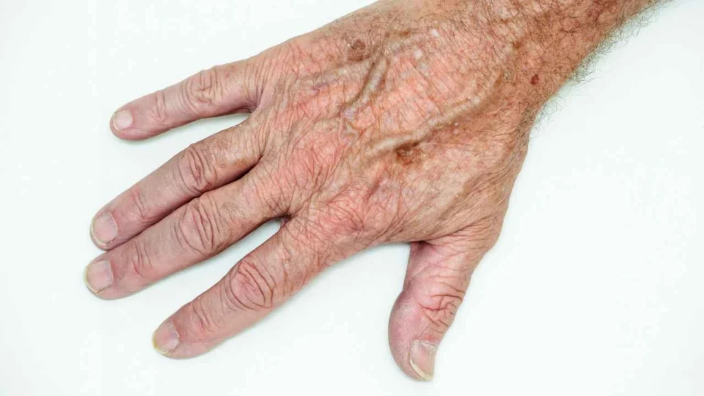 Male hand showing age spot Cheshire