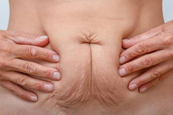 Image of a woman's stomach with loose skin - example of skin tightening Cheshire options