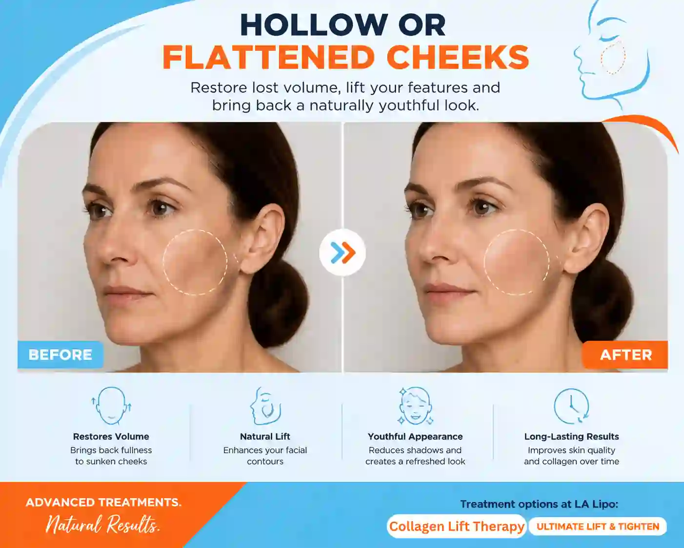 Sign #4: Hollow or Flattened Cheeks Cheshire