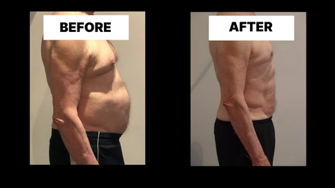 What Symptoms Can Diastasis Recti Cause in Men? Weak Core, Back Pain and Poor Posture Cheshire